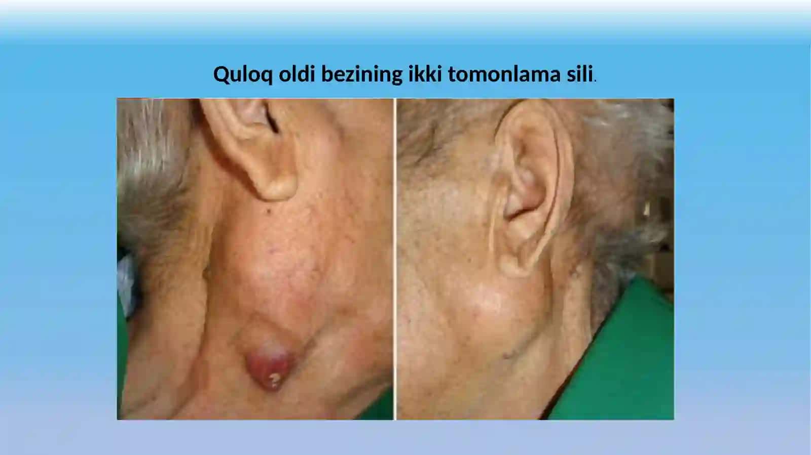 Silkasalligi 3