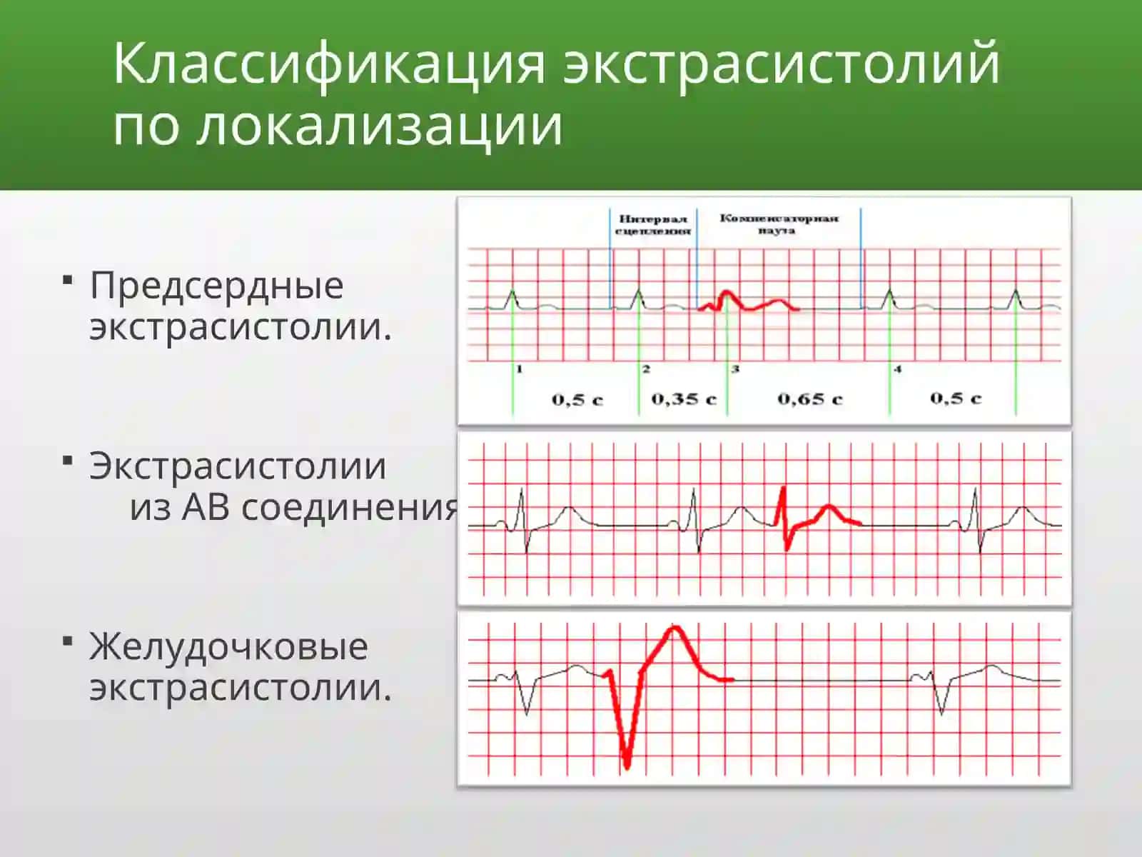 Экстрасистолии 3