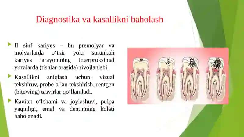 Blek bo‘yicha II sinfli kariyes kovaklarini restavrasiya qilishning klinik tamoyillari 3