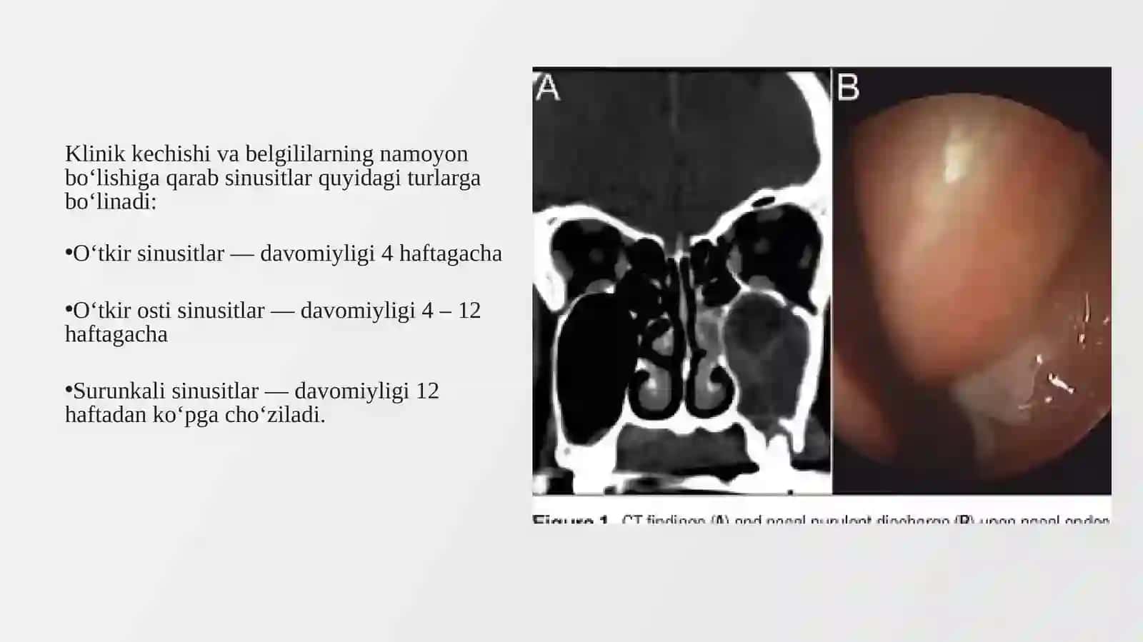 Odontogen sinusit 3