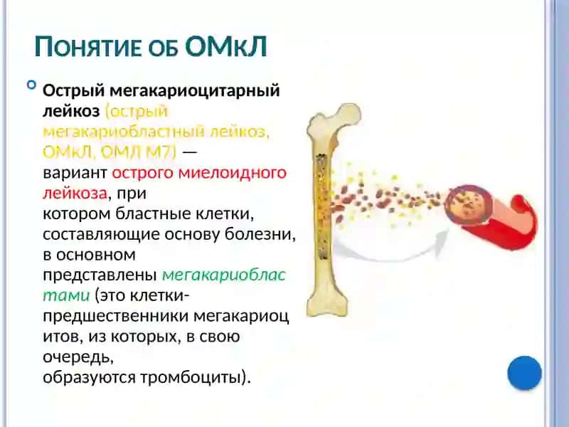 Острый мегакариоцитарный лейкоз 3