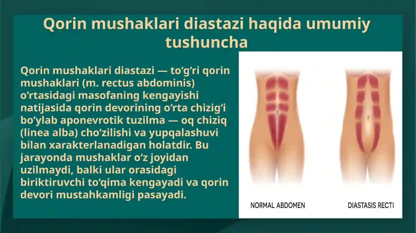 Qorinmushaklaridiastazi 3