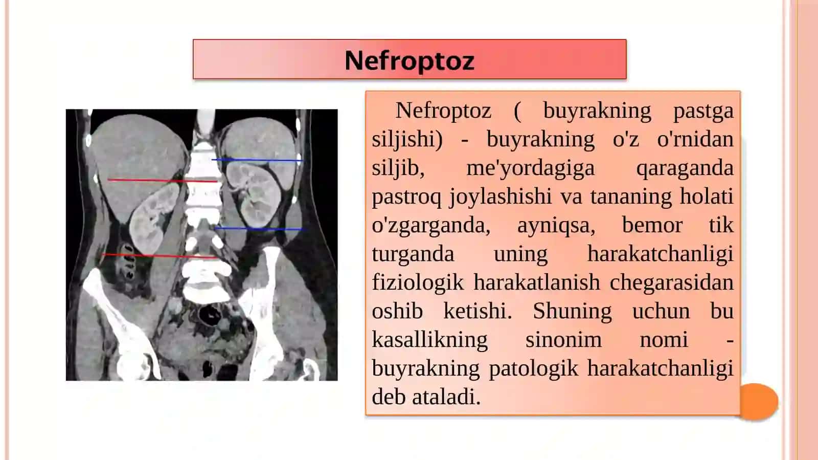 Nefroptoz 3