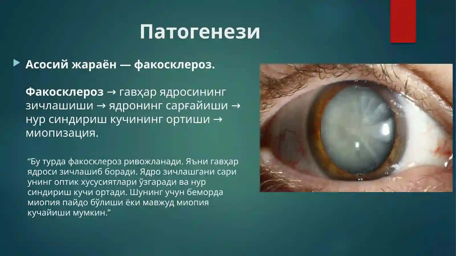 Ядроли катаракта 3