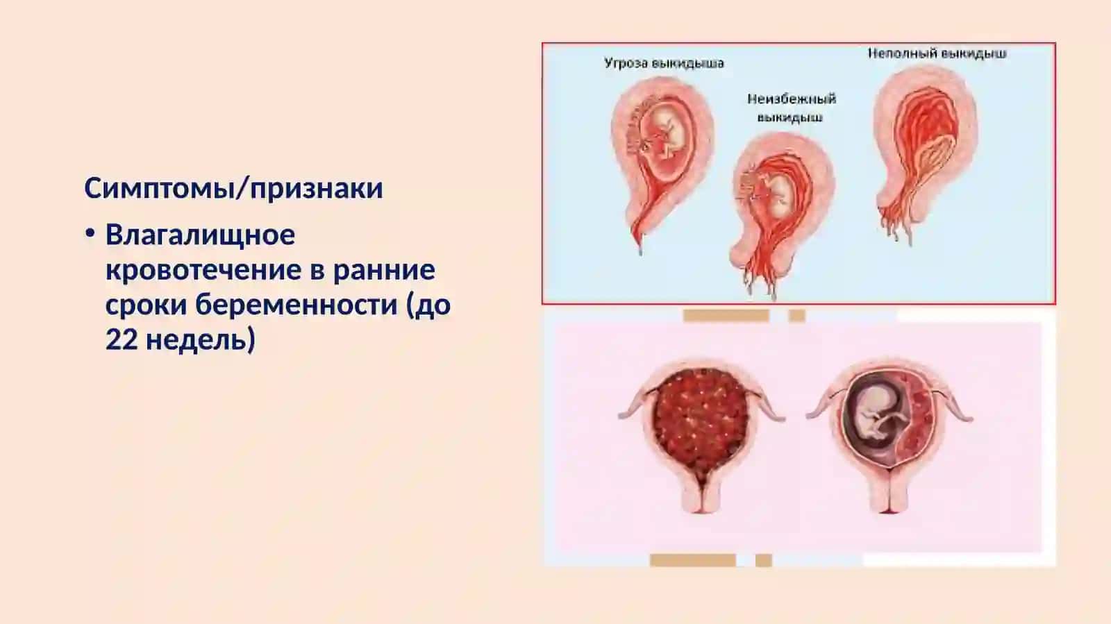Ведение беременных с кровотечениями в сроке беременности до 22 недель 3