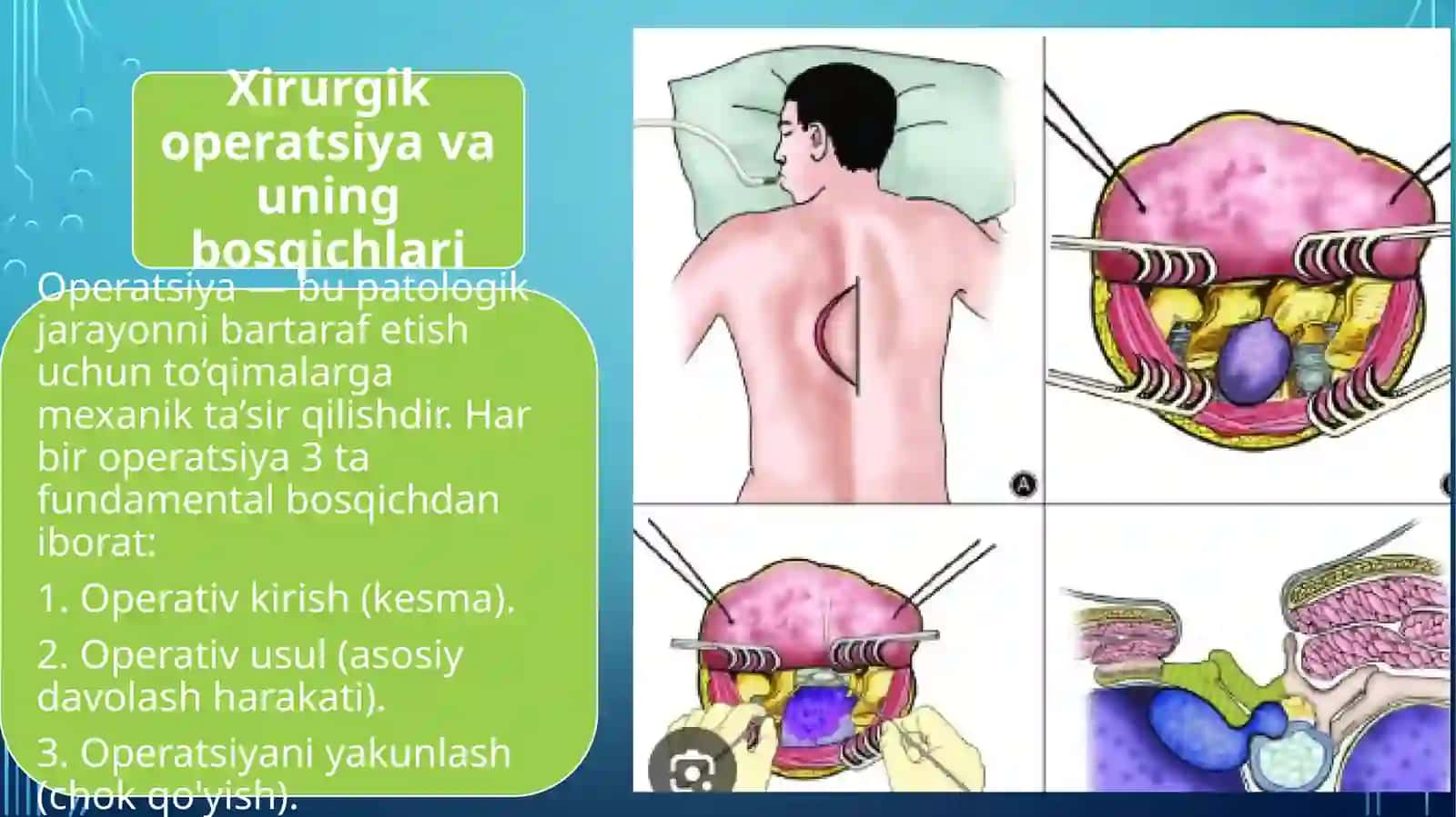 Mavzu:Xirurgik operatsiyalar tushunchasi,turlari.Operatsiyadan oldi va operatsiyadaan keyingi bemorlar parvarishi 3