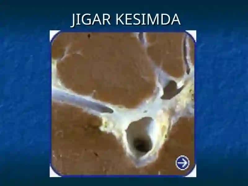 Jigar sirrozi 3