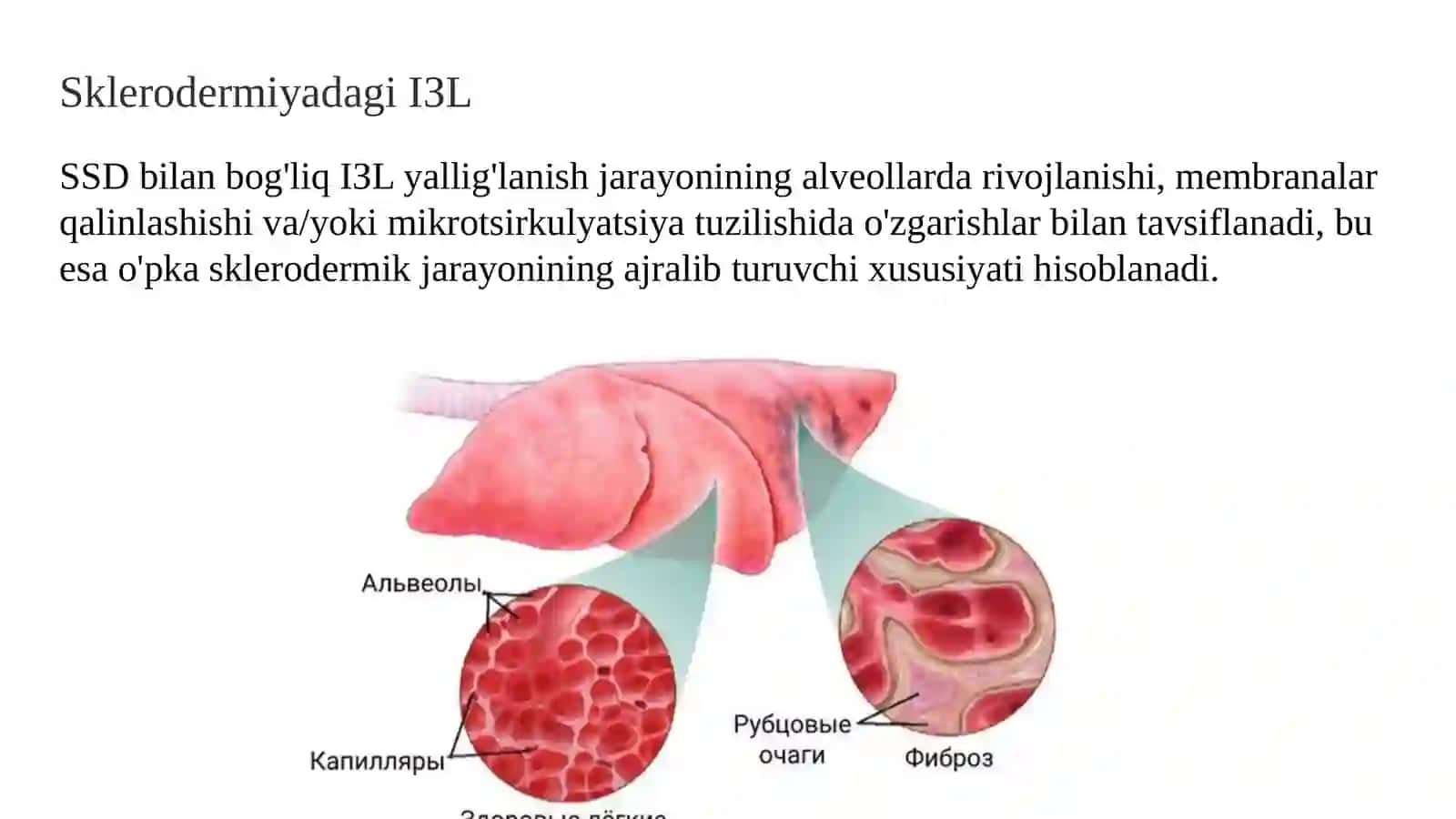 Sklerodermiyada o'pka interstitsial zararlanishi (1-variant) 3