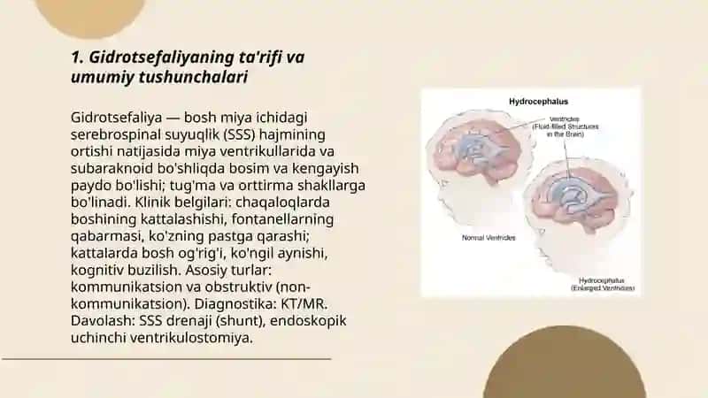 Gidrotsefaliya 3