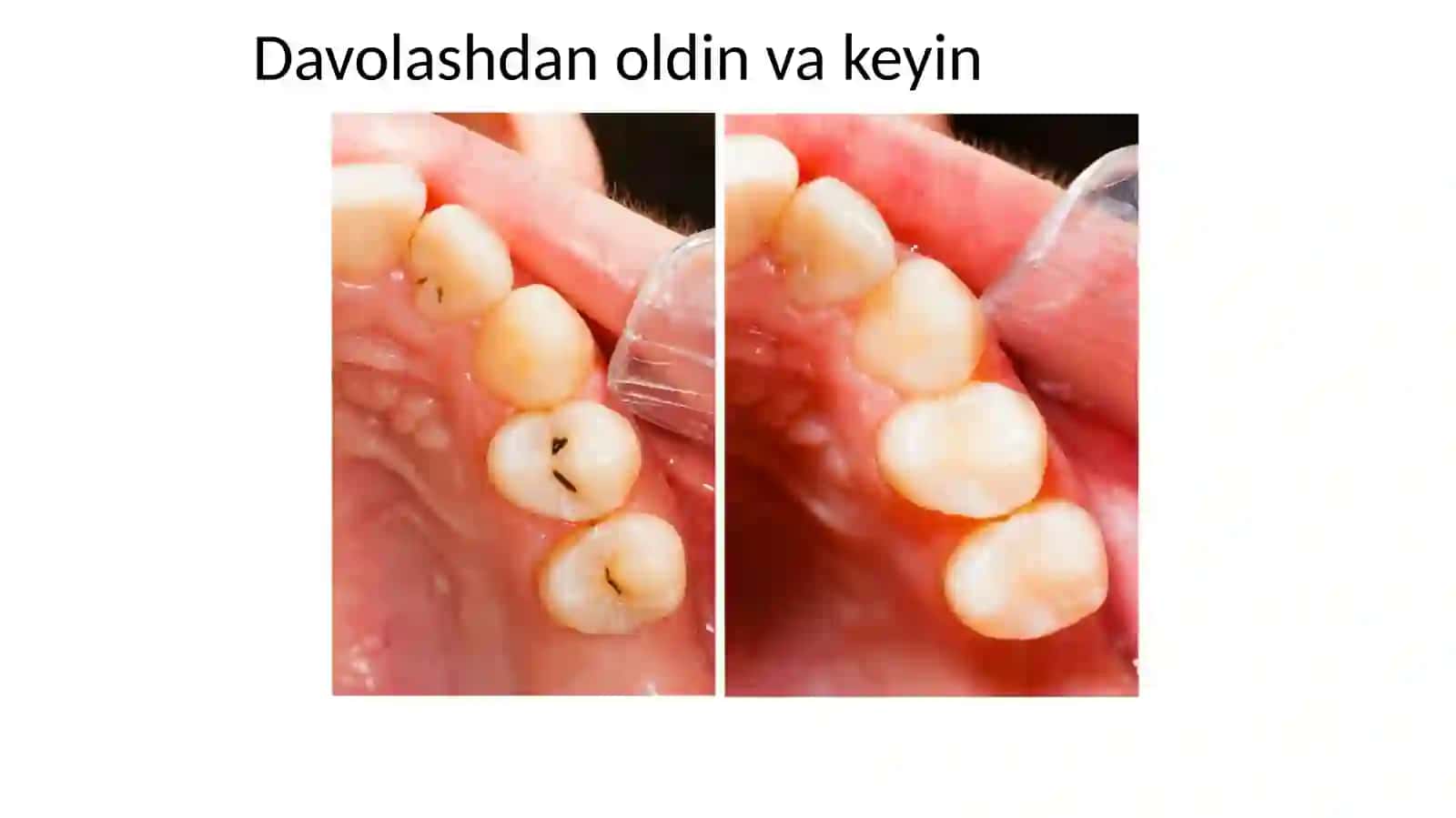 Blek bo'yicha VI sinf kariyes bo'shliqlarini to'ldirish. Plomba materiallari yordamida tish tojining 3