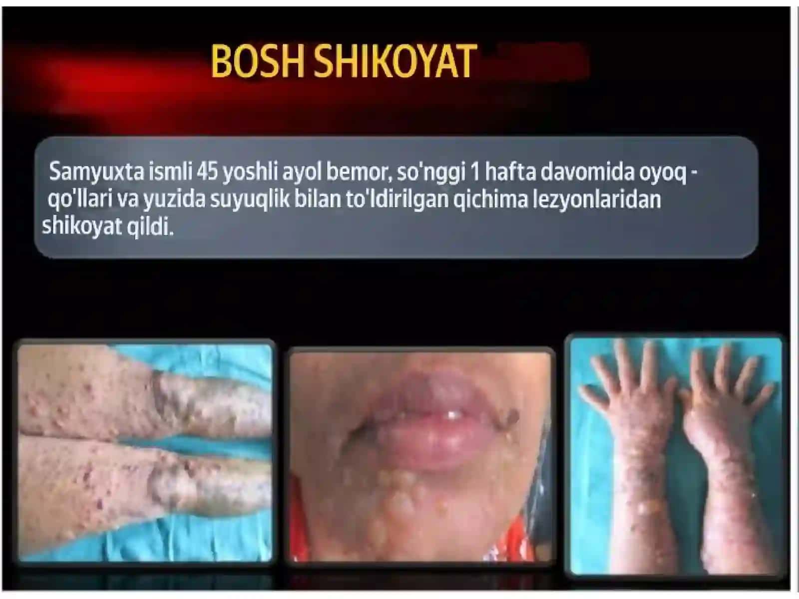 pemfigoiding ogʻiz boʻshligʻida namayon boʻlishi 3