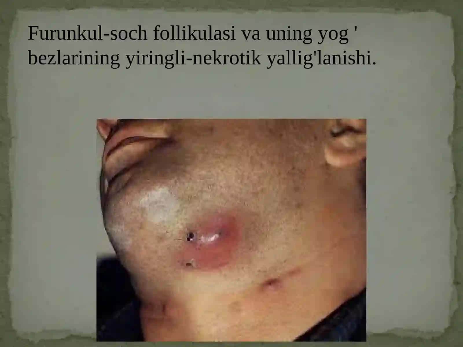Yumshoq to`qimalar nospets-fik infeksiyalari 3