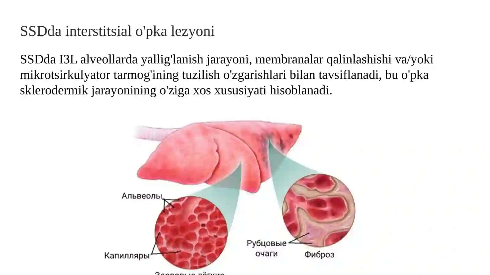 Sklerodermiyada o'pka interstitsial zararlanishi (2-variant) 3