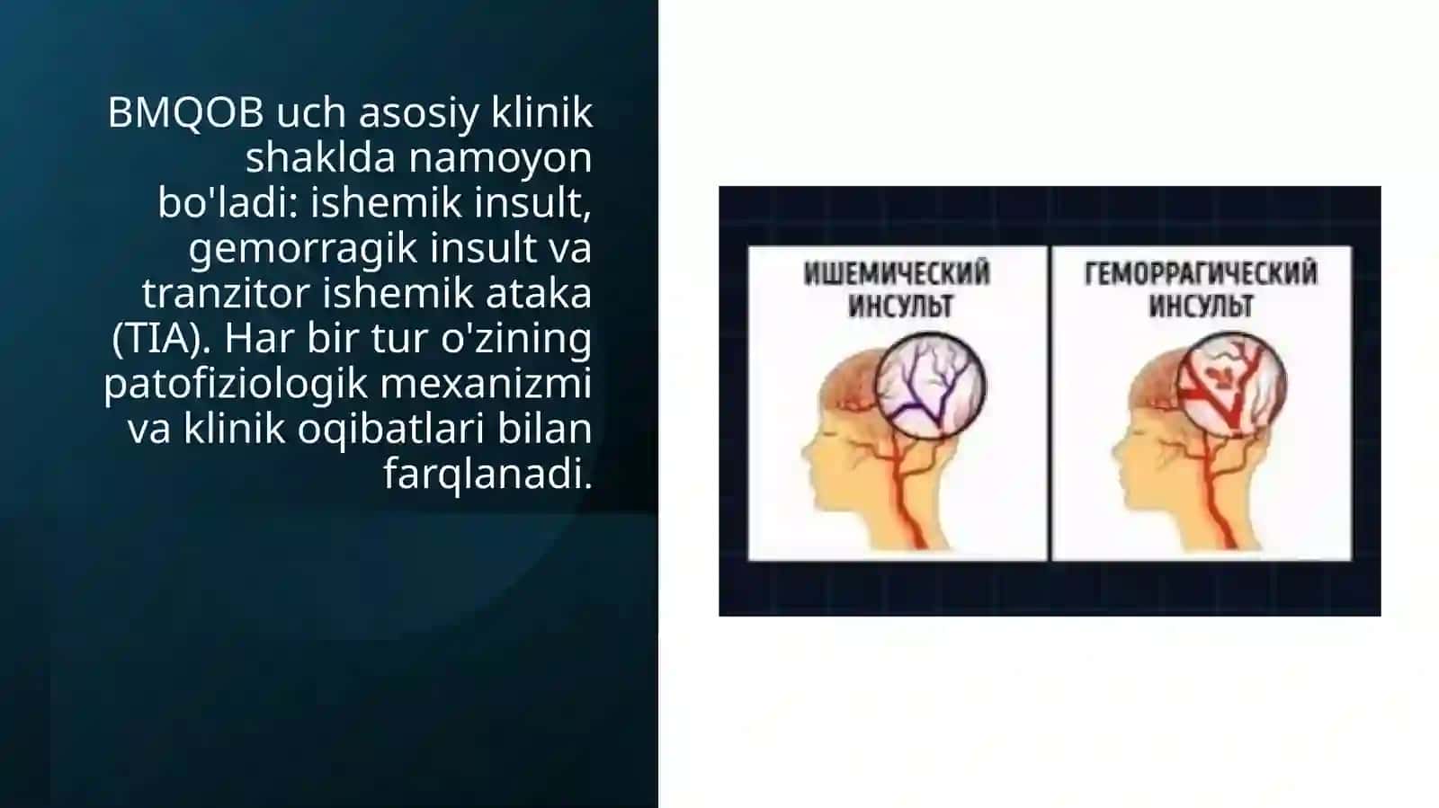Bosh miyada qon aylanishining o'tkir buzilishi 3