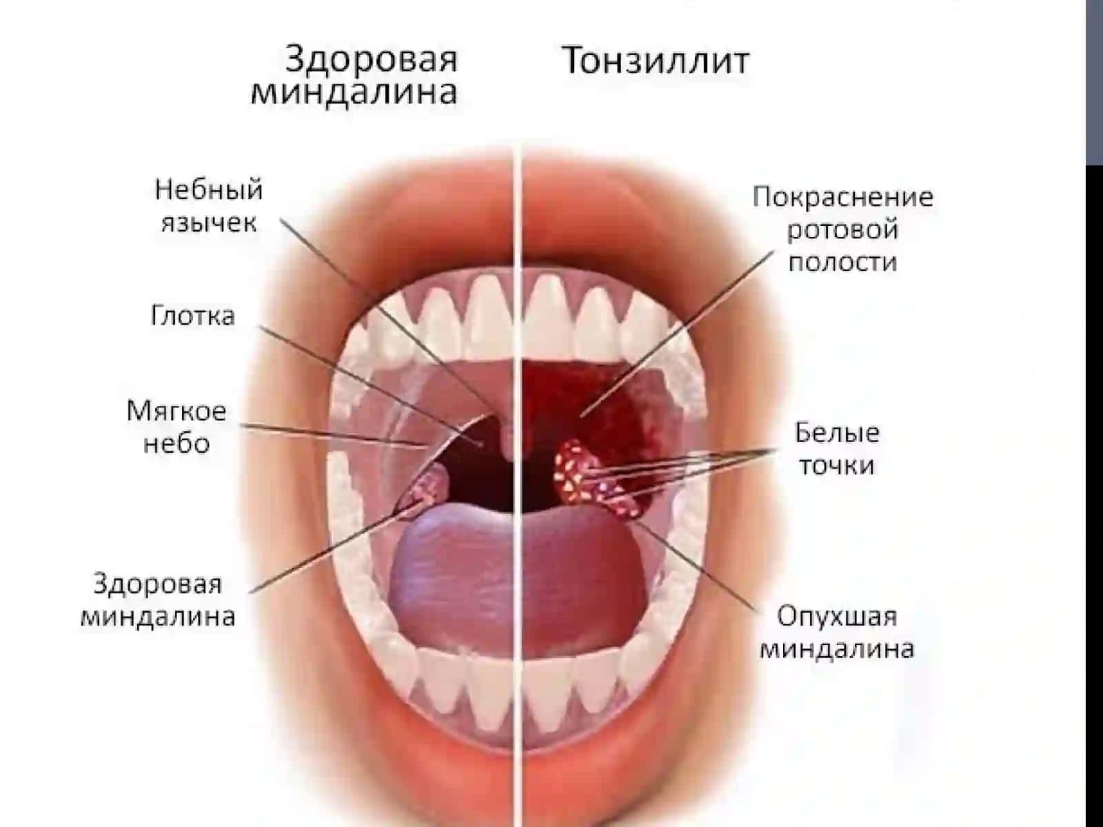 Angina 3