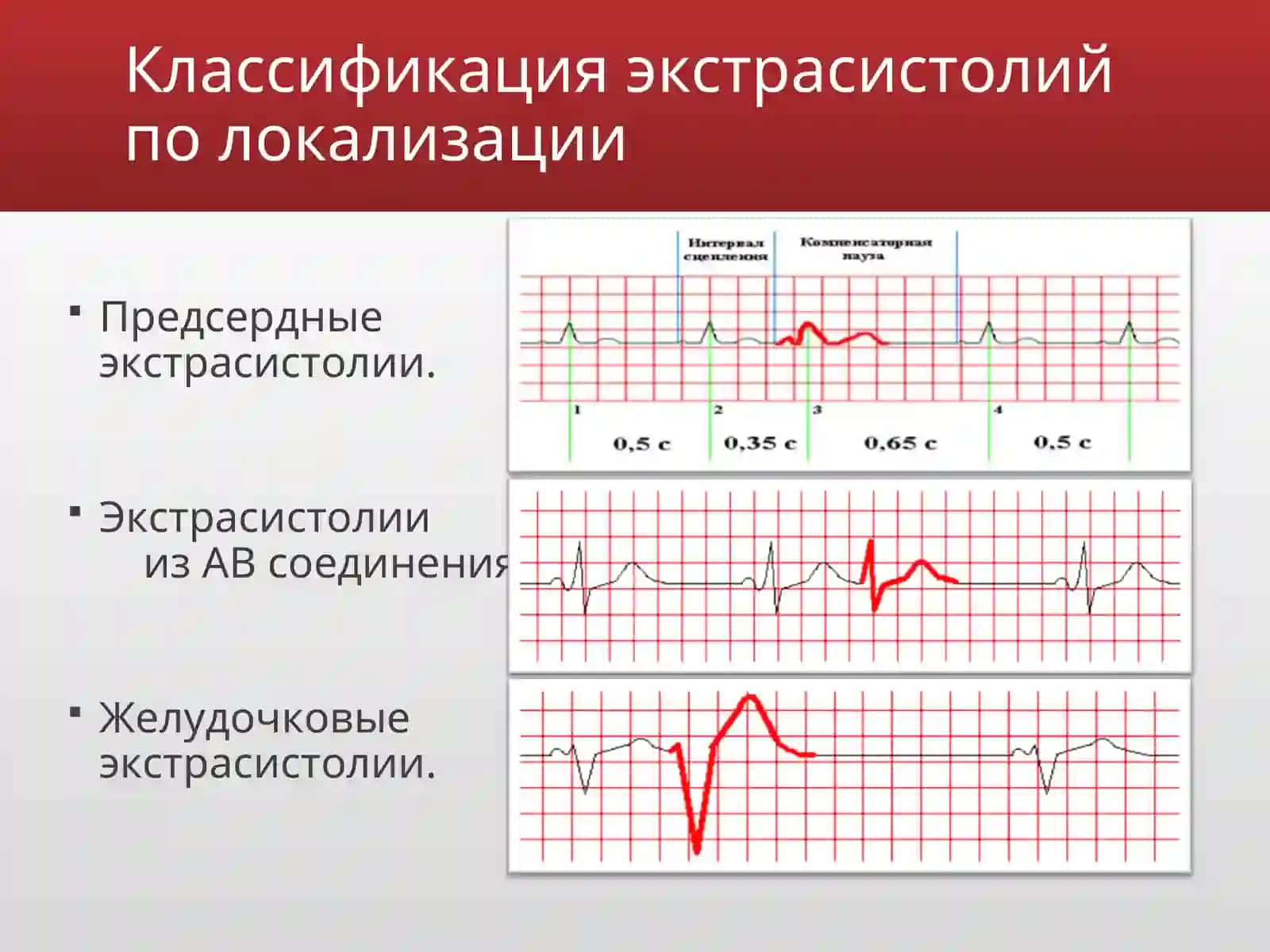 Экстрасистолии 3
