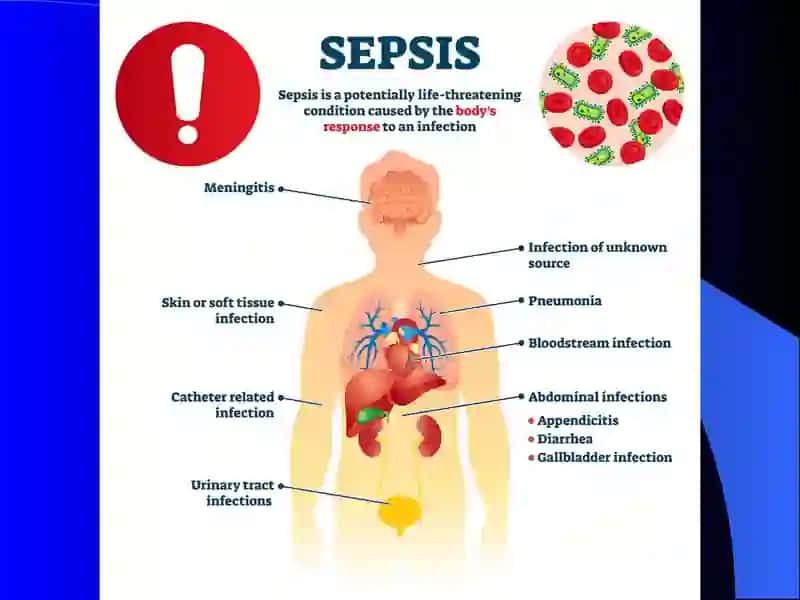 Sepsis 3
