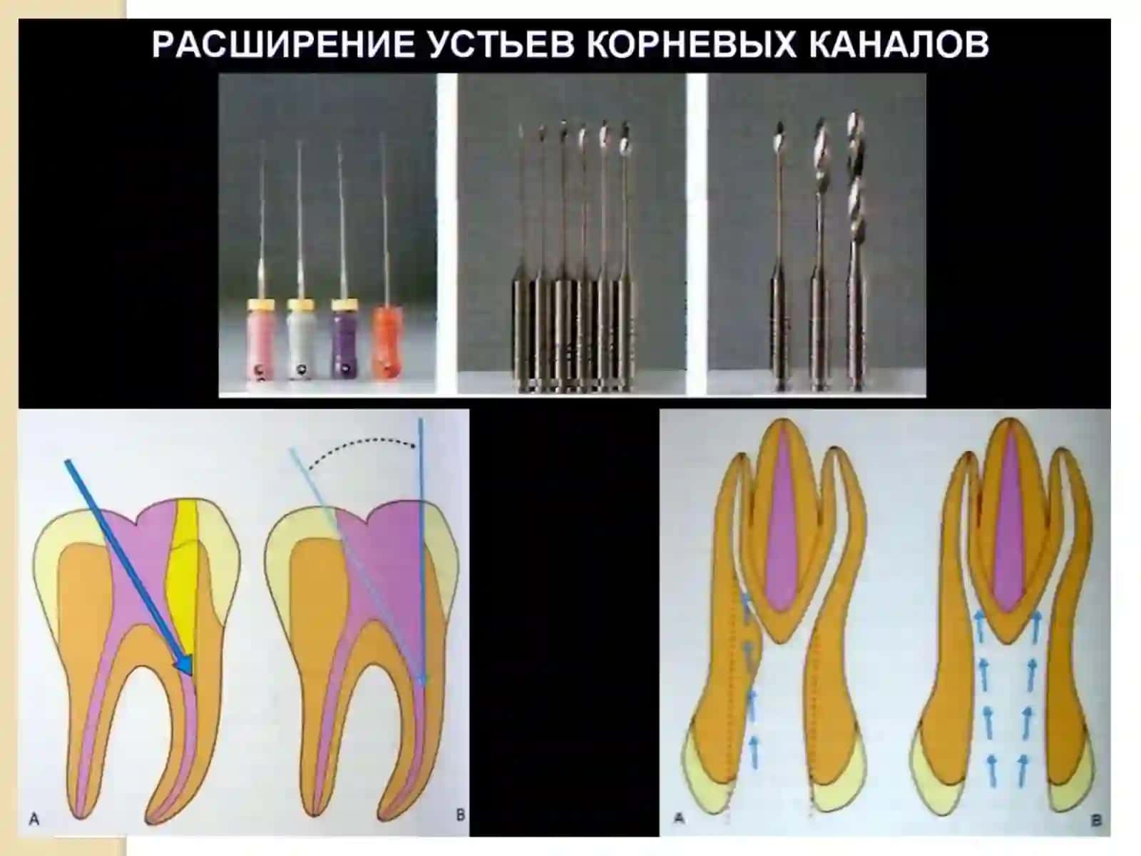 Методики обработки корневых каналов 3