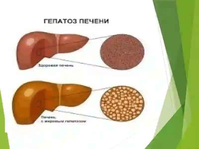 Гепатоз 3