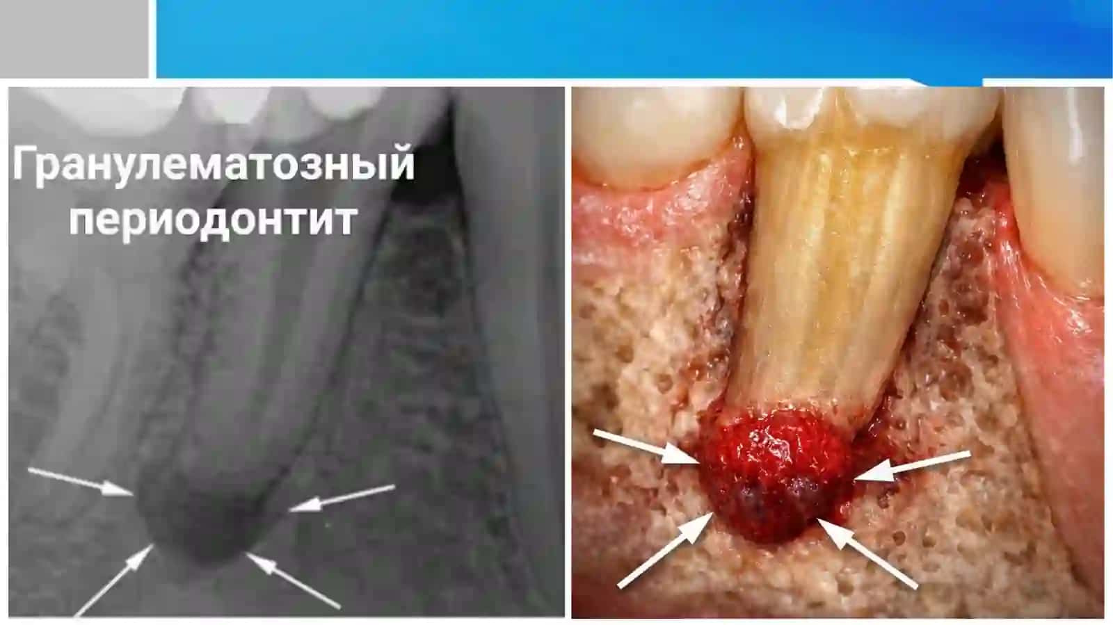 Surunkali granulematoz periodontit 3