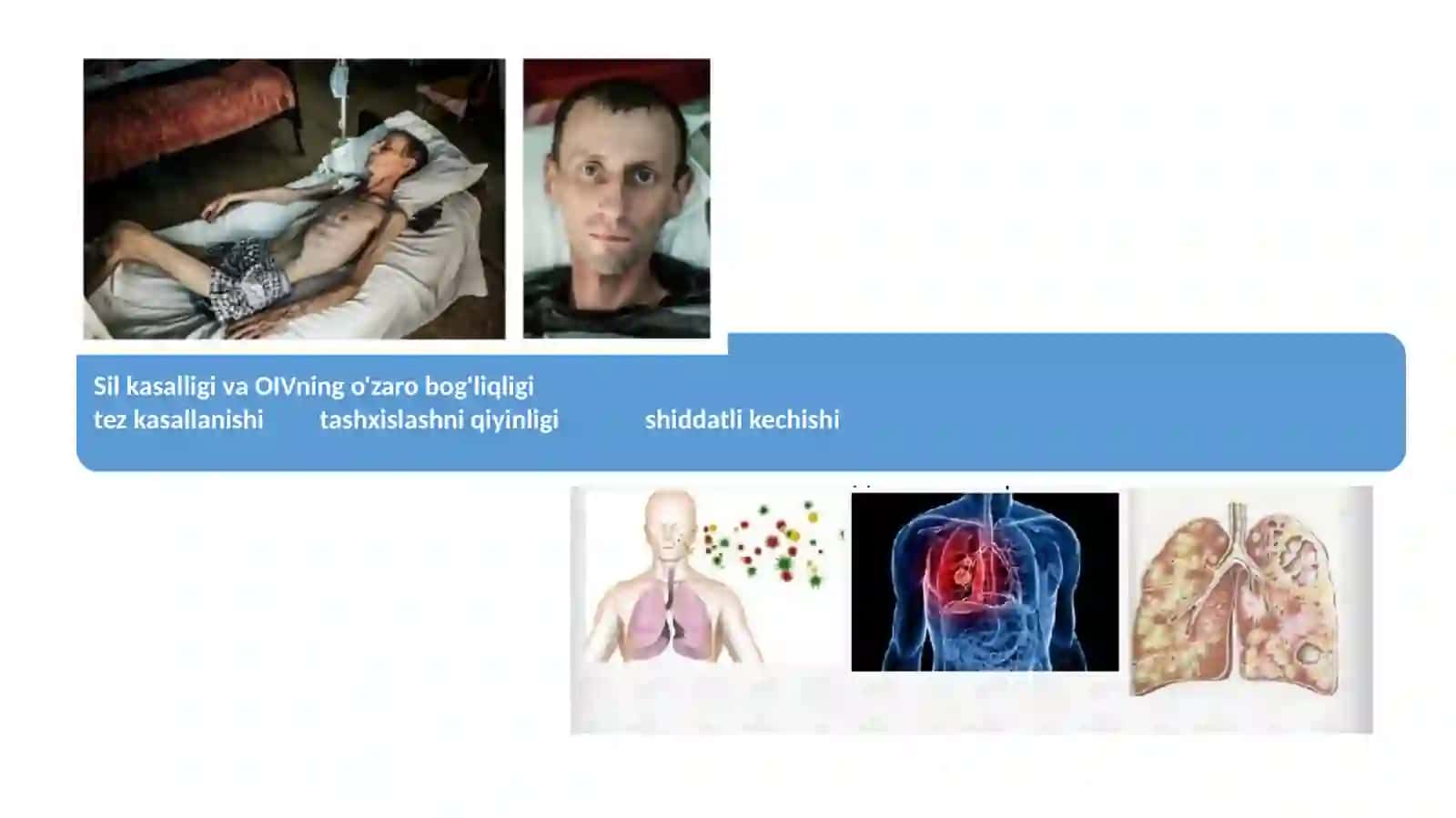 TB-OIV 3