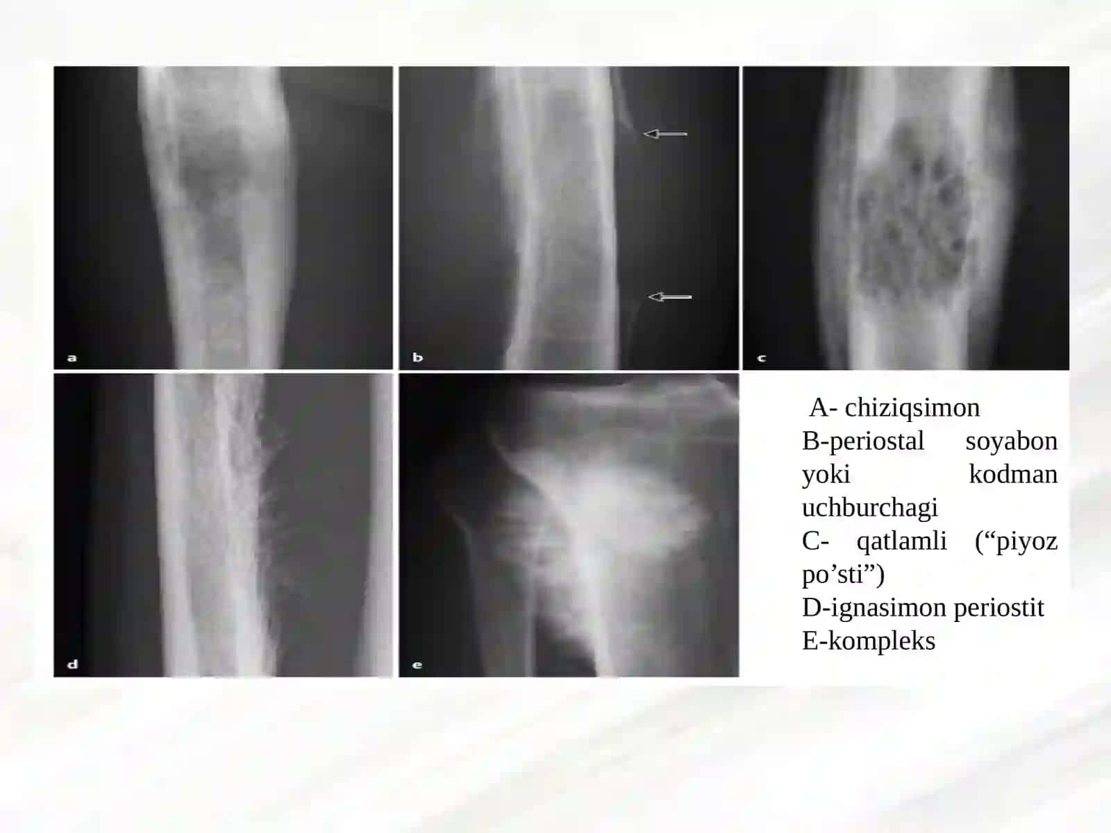 Suyak-bo'g’im kаsаlliklаrining nur tashxisi 3