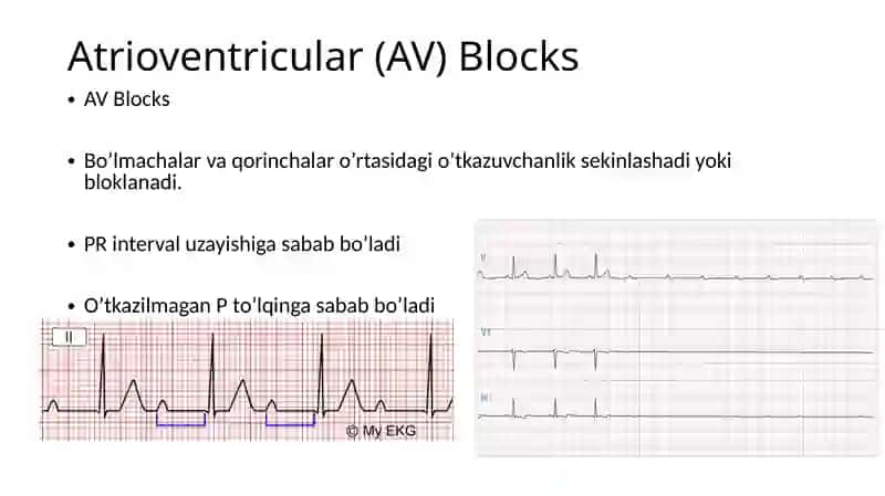 Atrioventrikulyar blokada 3