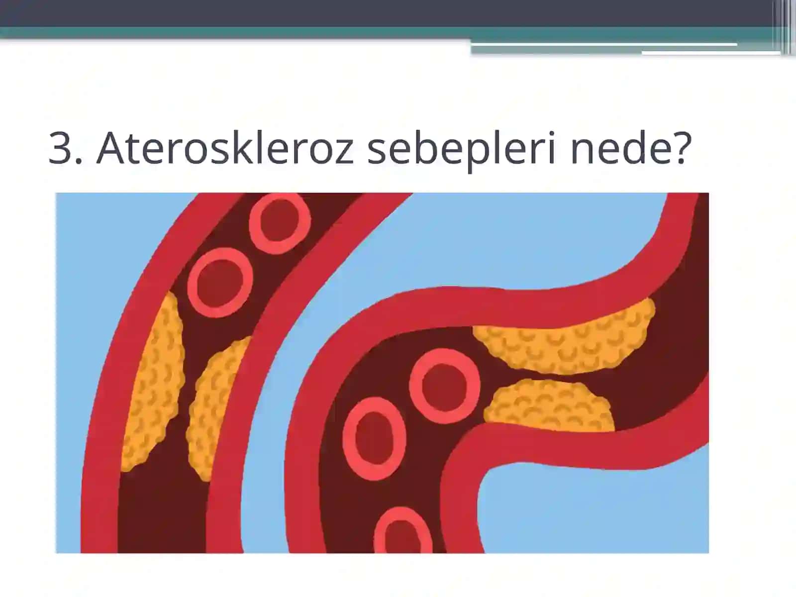 Ateroskleroz rawajlaniwi 3