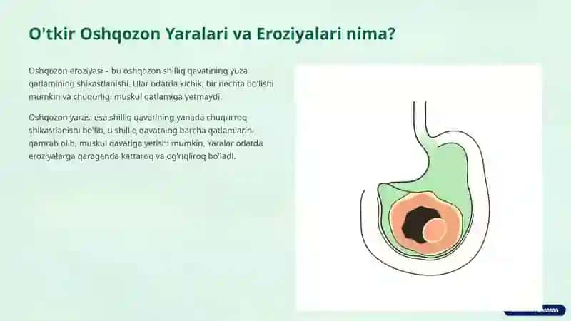 Oshqozon O'tkir Yaralari va Eroziyalari: Keng Qamrovli Qo'llanma 3
