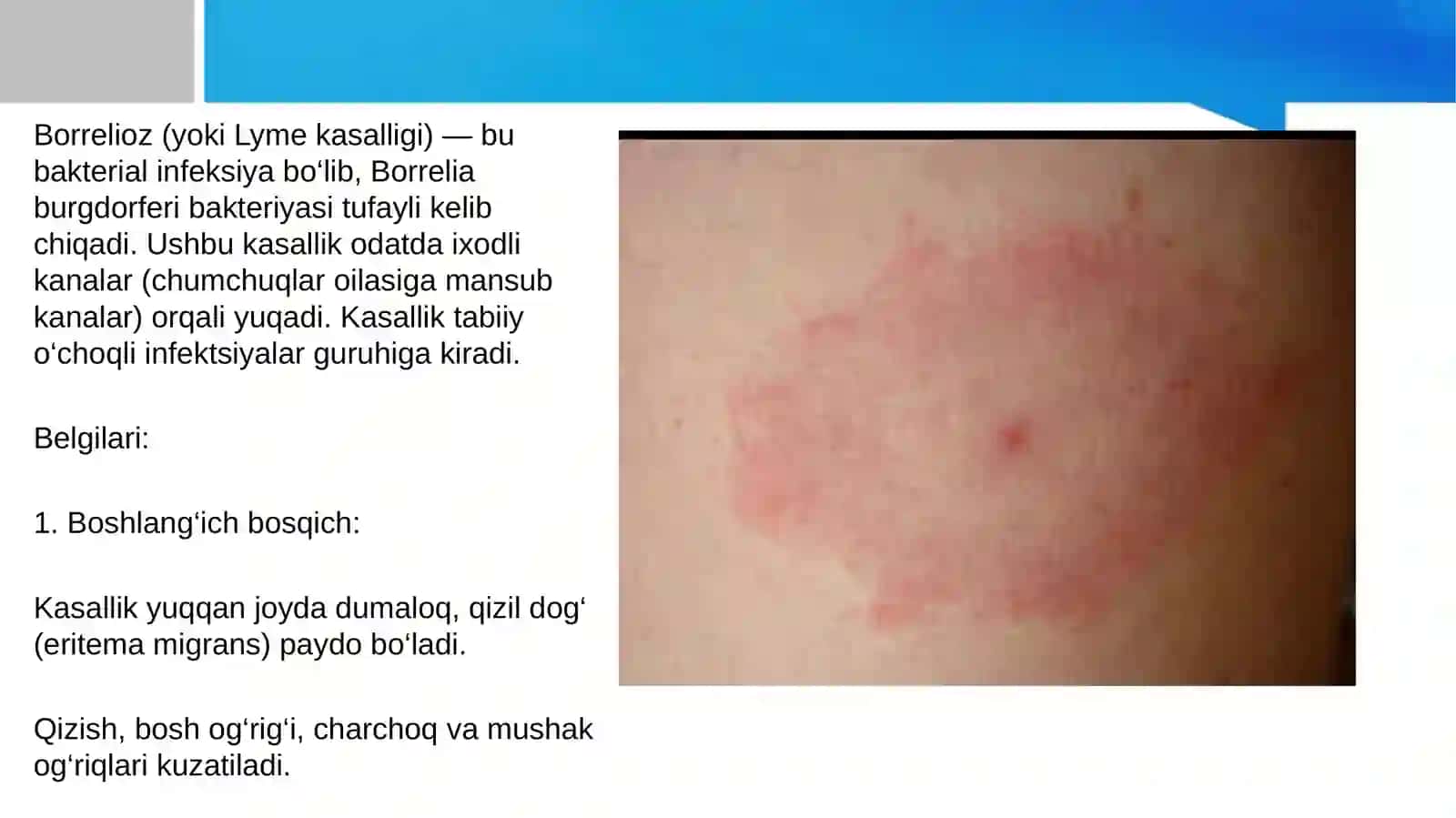 Borreliozlar morfologiyasi,strukturasi,tarqalganligi keltirib chiqaruvchi kassaliklar 3