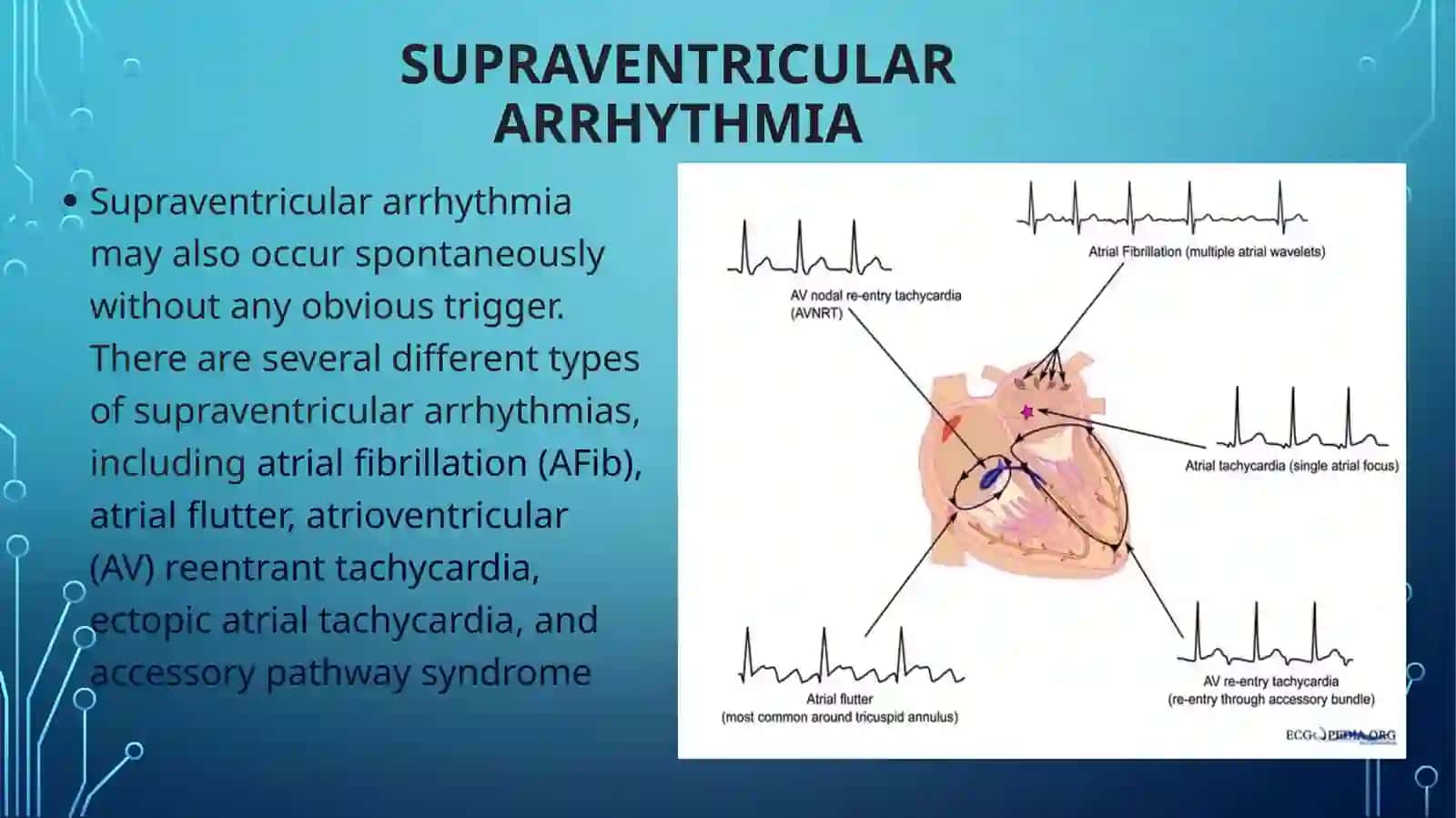 Supraventricular arrhythmia 3