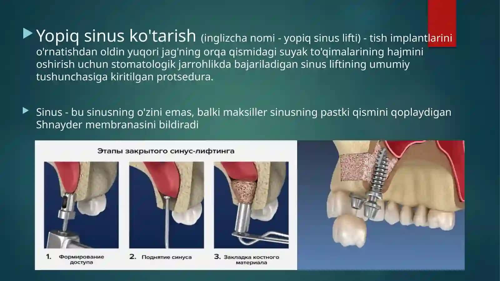 Sinuslifting operatsiyasiga ko’rsatma va qarshi ko’rsatmalar 3