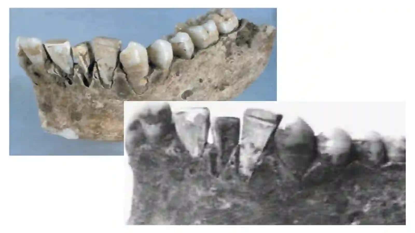 Dentalimplantlar tarixi 3