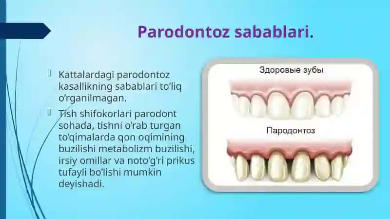 Bolalarda Parodontoz 3