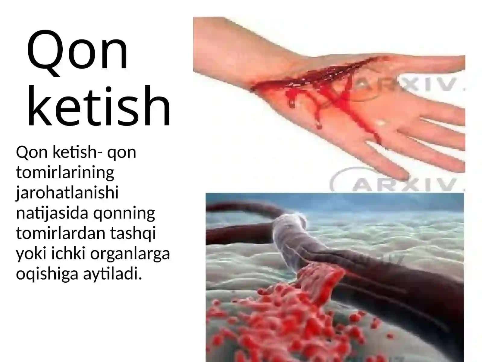 Qon ketish 3