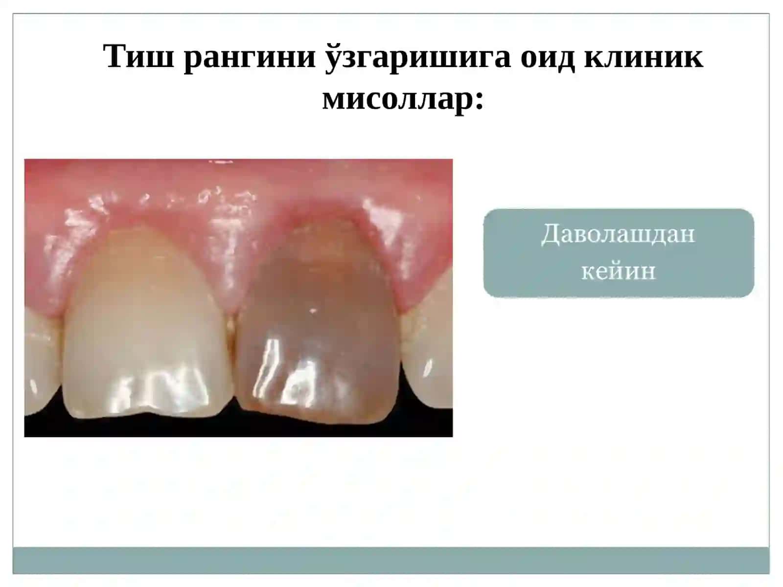 Тиш ранжи 3
