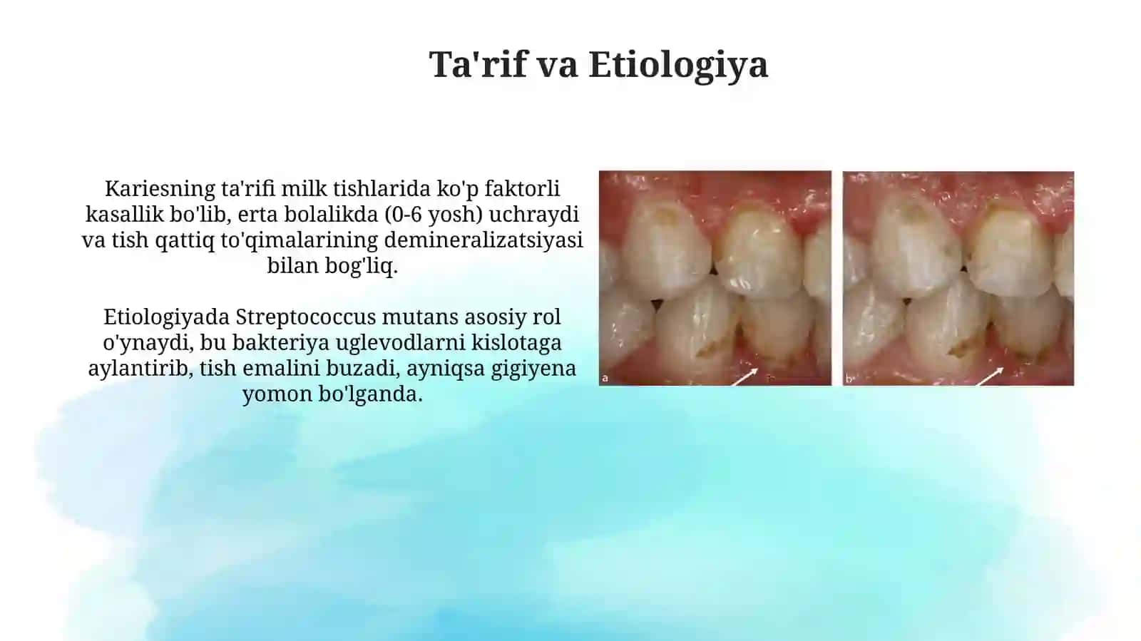 Bolalar stomatologiyasida sut tishlari kariesining xususiyatlari 3