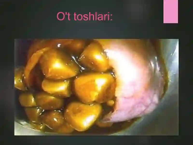 O't tosh kasalligi taqdimod pptx 3