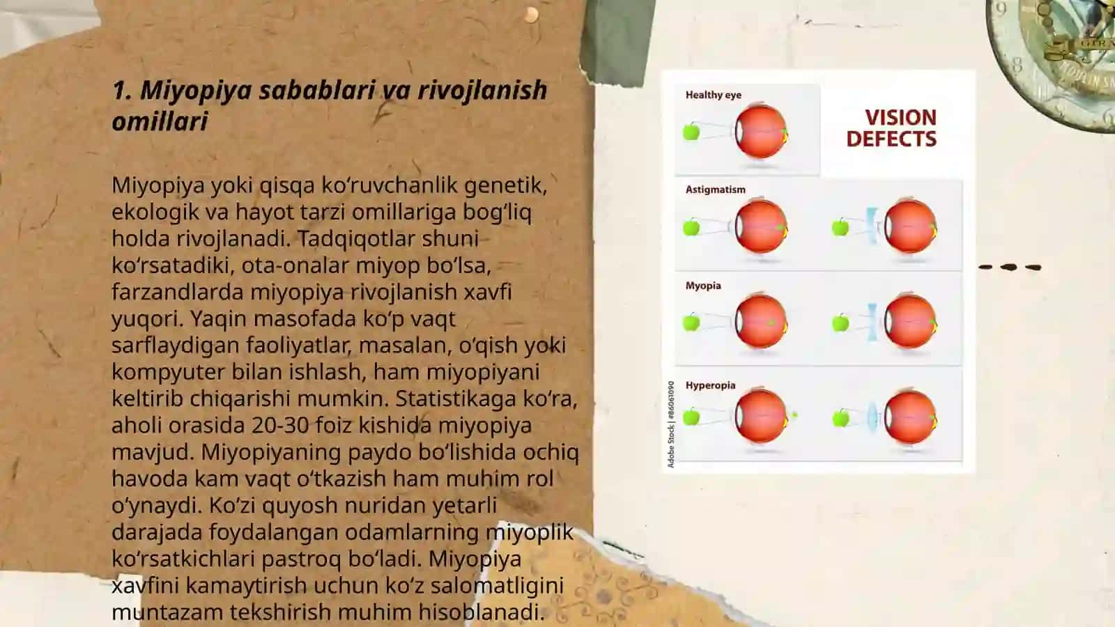 Miopiya va Gipermetromiya kasaligi va ularning diagnostikasi 3