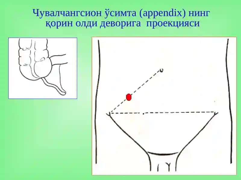 Ўткир аппендицит 3