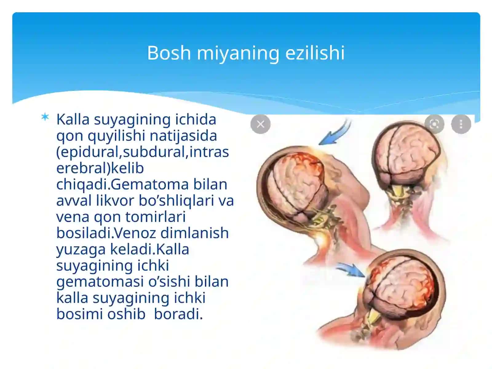 BOSH MIYA TRAVMALARI 3