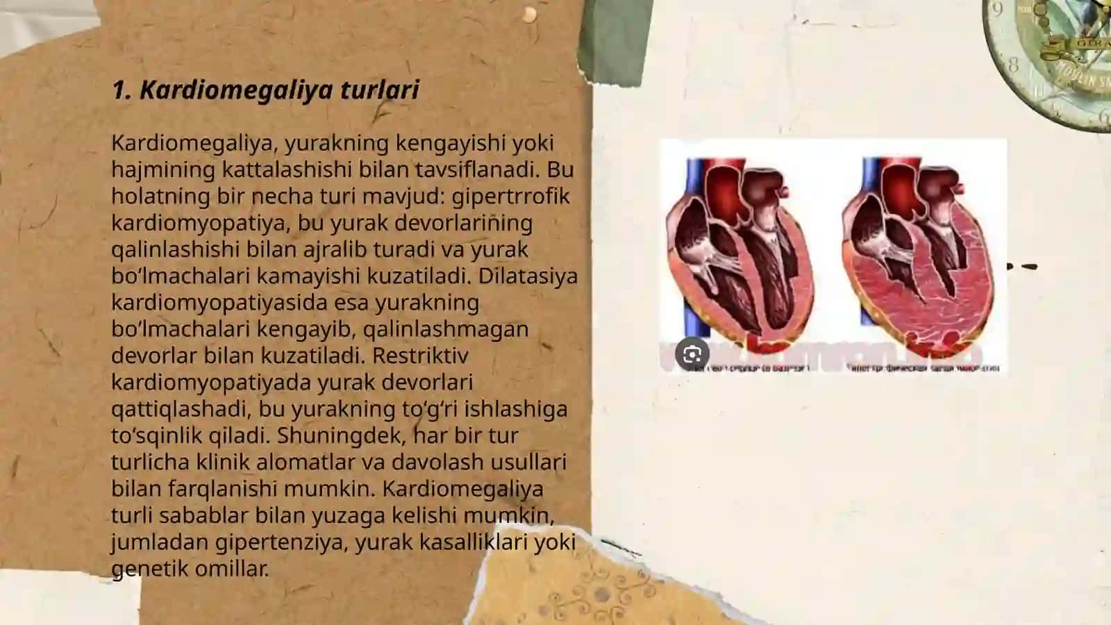 Kardiomegaliya turlari 3