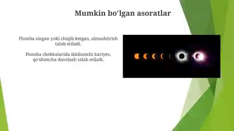 Kompazit plomba ashyolari haqida tushuncha 3