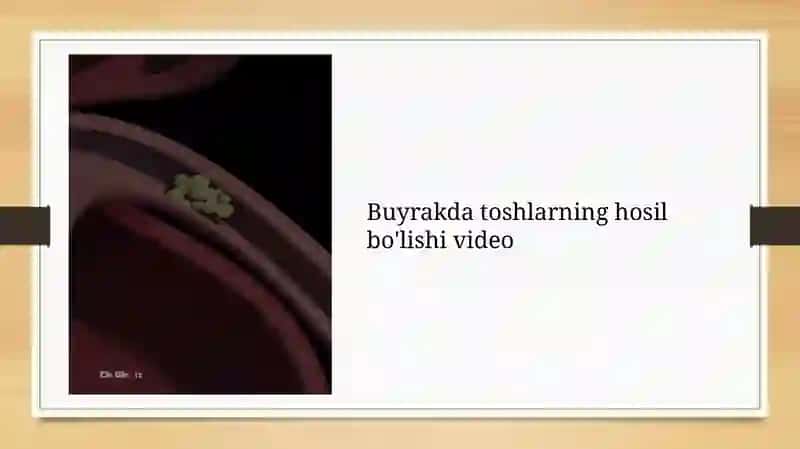 Buyraklarda urat toshlarining hosil bo'lishi va ularning davolash yo'llari 3