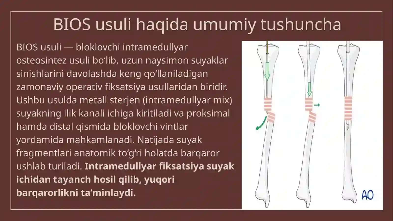BIOS usuli (bloklovchi intramedullyar osteosintez) 3