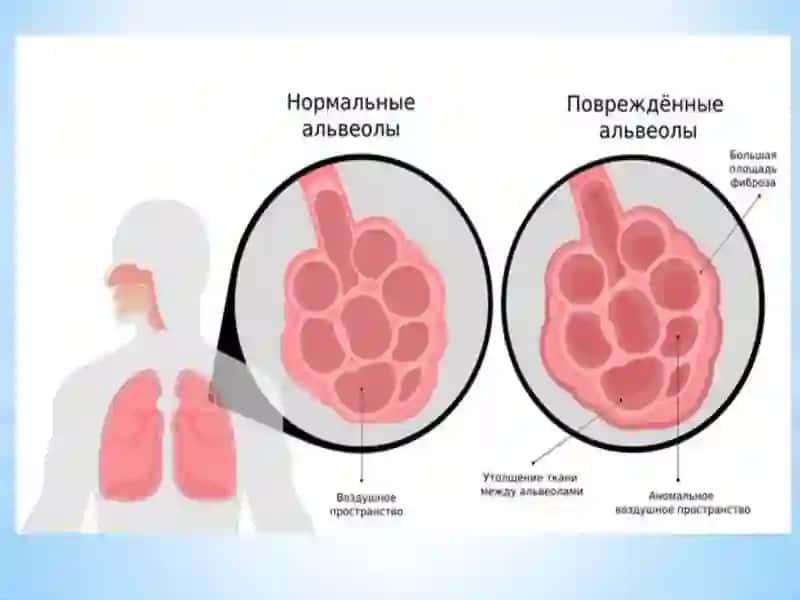 ALLERGIK ALVEOLIT 3