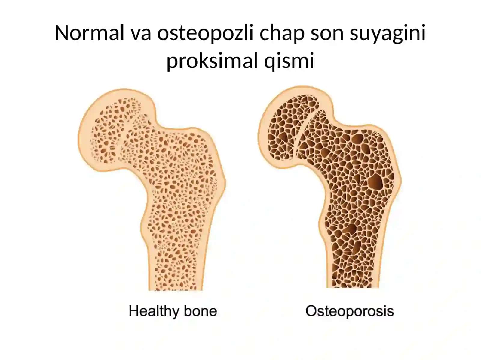 Osteoporoz kasalligi 3