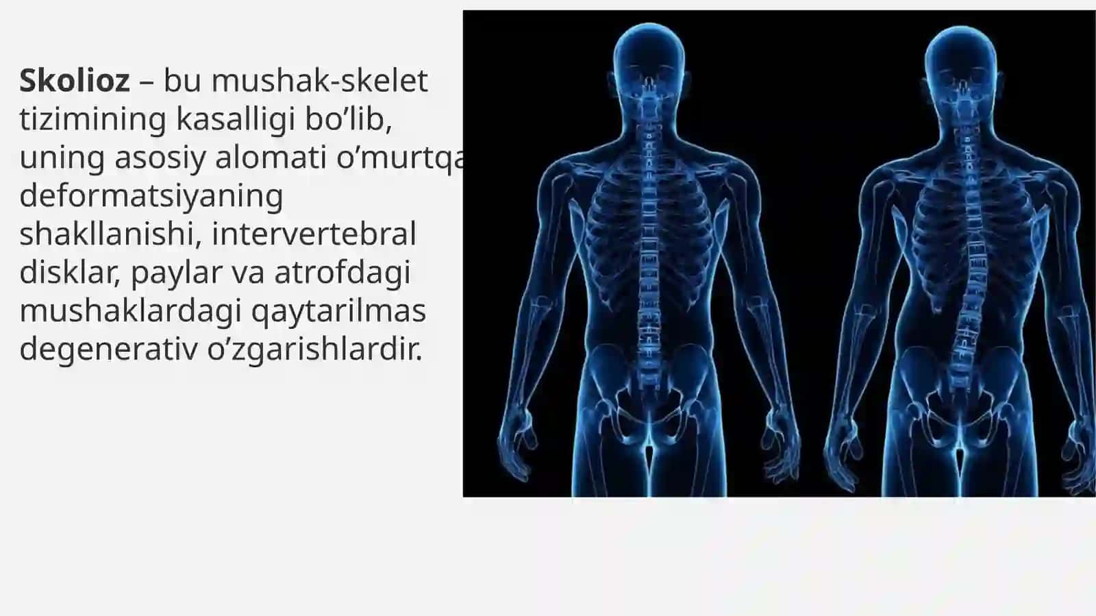 Skolioz 3
