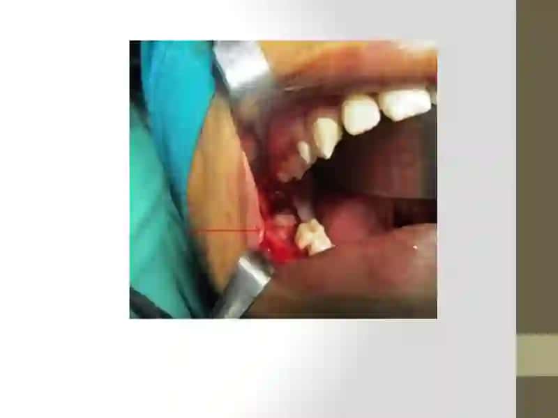 Odontoma 3