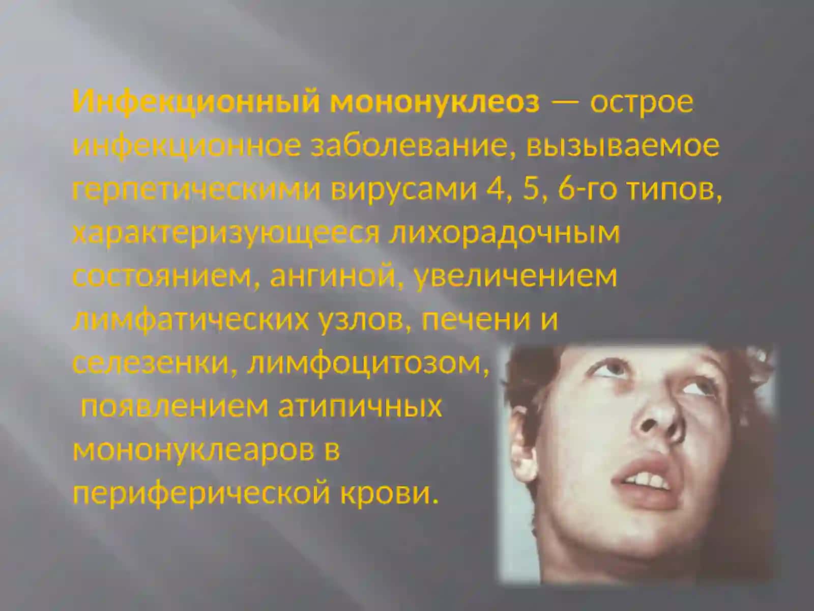 Инфекционный мононуклеоз 3